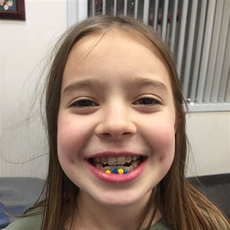 smiley face orthodontics|smiles hollywood orthodontics.